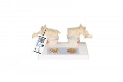 Model dydaktyczny osteoporozy - 3B Smart Anatomy - 1000182 [A95]